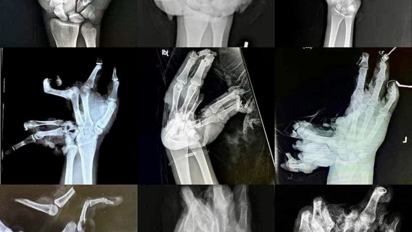 Sokkoló képekkel figyelmeztetnek a mentők - megyénkben is történt már petárdabaleset
